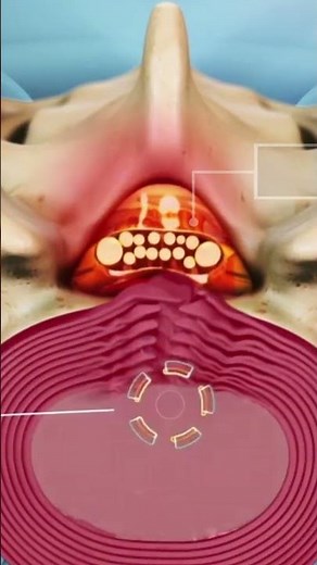 Compression of the Cauda Equina in the Lumbar Spine