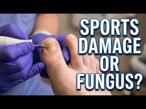 Long Second Toe Destroying His Nails: Here's What We Found