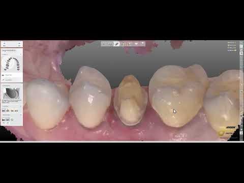 3shape full contour design