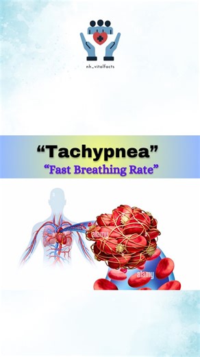 Nazmul on Instagram: "Tachypnea is a sign, not a disease—always identify and treat the underlying cause. Seek medical help if rapid breathing is persistent or severe. . . . #Tachypnea #FastBreathing #RespiratoryHealth #Pneumonia #Asthma #ARDS #BackToBasics #NHVitalFacts"