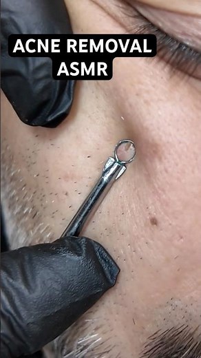 Most Satisfying Acne Clearing ASMR 🤯✨ #shortsasmr