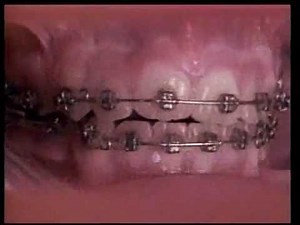 Time lapse: Dental Braces 18 months