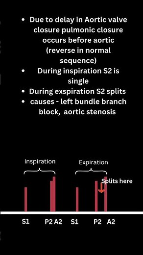 Heartbeat secrets: Paradoxical S2 split revealed! #cardiacheart