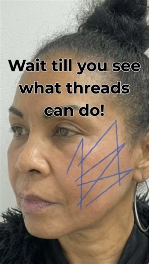✨PDO Thread Lift: Your Non-Surgical Facelift Solution! Have you ever wondered how to achieve a lifted, youthful appearance without going under the knife? Let's talk about the PDO Thread Lift, one of my favorite treatments for subtle yet stunning results! ✨What is it? PDO threads are dissolvable sutures designed to lift sagging skin and stimulate collagen production. They work beneath the skin to give you a refreshed, natural-looking lift. ✨Why choose PDO Threads? V Instant Lift: See results righ