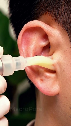 FROM CLOGGED TO CLEAN EAR ASMR ✨#earasmr #blackheadremoval #relaxing