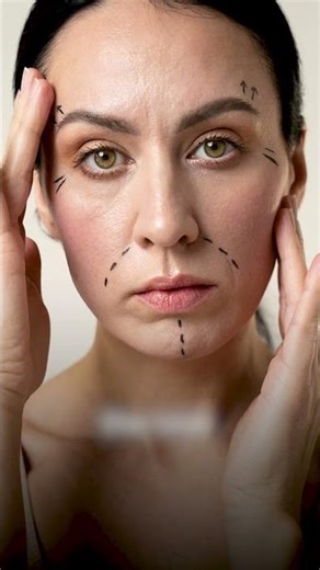 Chin Implant with Rhinoplasty & Neck Liposuction | Facial Harmony Transformation