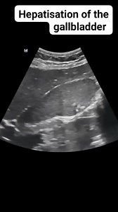 Hepatisation of the gallbladder with intraluminal stones. Hepatisation of the gallbladder is usually well seen on ultrasound. It occurs when the gallbladder content appears echogenic, similar to hepatic parenchyma. It is usually seen in cases of longstanding bile stasis whatever the cause, e.g. post-infection, with and without stones and even incidentally. | Radiology Interesting
