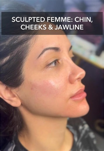 Facial Aesthetics: Jawline and Cheek Sculpting Treatment