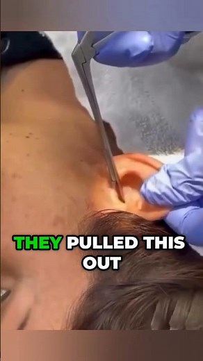 They Pulled THIS from Her Ear—Alive 🪳