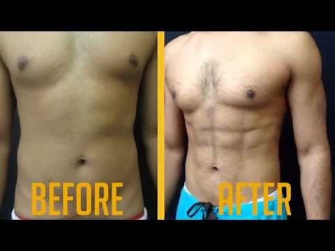 Vaser Hi-Def Liposuction Male Before/After Video - Advanced Lipo Centre