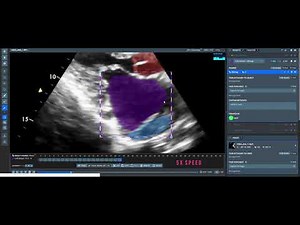 Heart segmentation on Ultrasound Videos with Supervisely and Custom Smart Tool