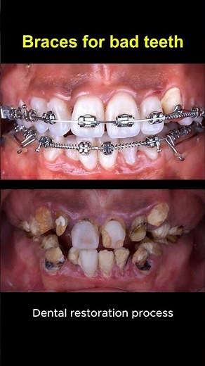 Restore bad teeth and braces #braces #orthodontist #dentist #teeth