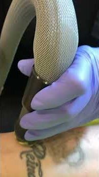 Tattoo Removal with the PicoWay laser at Well Medical Arts in Seattle