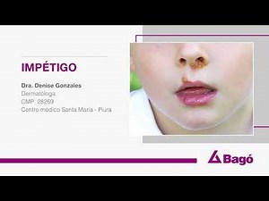 EL IMPÉTIGO ES LA INFECCIÓN BACTERIANA DE LA PIEL MÁS COMÚN EN L@S NIÑ@S