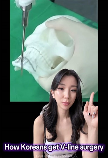 Understanding V-Line Surgery in South Korea