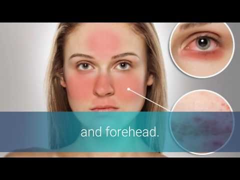 Rosacea And Lupus