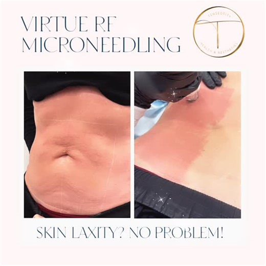 Tensegrity Health & Aesthetics on Instagram: "Struggling with skin laxity—looser jawline, crepey neck, or thinning skin? Let’s talk about why Virtue RF Microneedling by Cartessa is one of our favorite tightening treatments 💉✨ How it works: Microneedling creates controlled micro-injuries that trigger fresh collagen + elastin, while radiofrequency energy heats the dermis to tighten existing collagen and rebuild deeper support structures. This combo means firmer, smoother, more lifted skin 