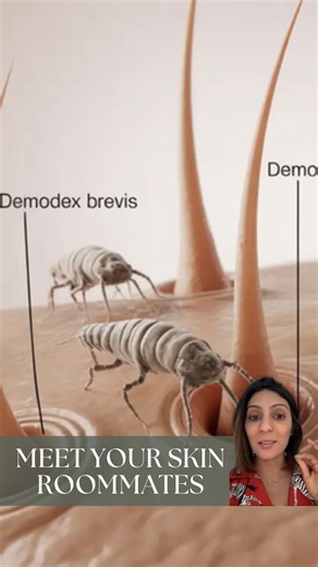 𝐅𝐨𝐫𝐮𝐦 𝐏𝐚𝐭𝐞𝐥, 𝐌𝐃, 𝐅𝐀𝐀𝐃 on Instagram: "Yes, tiny mites live on your face — and that’s normal. Demodex mites naturally inhabit hair follicles and sebaceous glands. Problems start only when their numbers increase. When to suspect overgrowth: -Persistent itching or burning -Rosacea-like redness -Acne that doesn’t respond to usual treatments How to keep them in check: -Gentle cleansing with sulfur based face wash -Avoid heavy, greasy products -Treat underlying skin conditions -See a de