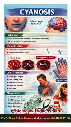 Cyanosis: When oxygen falls, the skin tells the story. #cyanosis #hypoxia #medicalawareness #neet