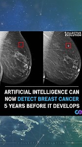 This is what we want to see AI doing. AI is transforming breast cancer detection, offering the ability to identify risks up to 5 years before cancer develops. Tools like Mirai, AsymMirai, and Transpara analyze mammograms with incredible precision, spotting patterns and anomalies that may go unnoticed by human eyes. By detecting cancer risks early, these technologies not only save lives but also allow for personalized care, faster diagnoses, and reduced healthcare costs. This tech is being furthe