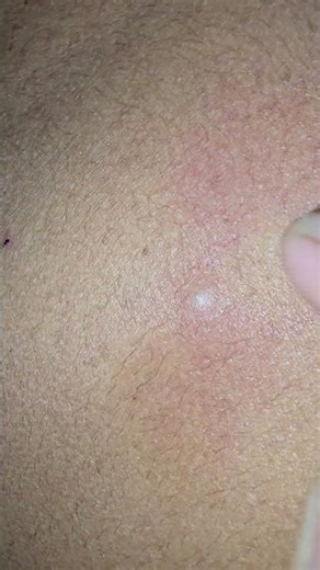 Sebaceous cyst Punctum