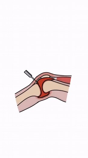 💉 Joint Aspiration Explained When a patient presents with a swollen, painful joint, one important step is aspiration — using a needle to withdraw joint (synovial) fluid for lab analysis. This helps us find out the cause of the swelling. 🔬 What we may see under the microscope: 👉 Septic Arthritis – very high white blood cells, bacteria identified on Gram stain/culture. 👉 Gout – needle-shaped monosodium urate crystals, negatively birefringent. 👉 Pseudogout – rhomboid-shaped calcium pyrophospha