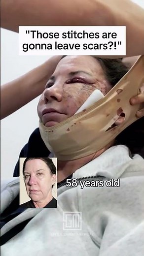 Here’s what a real Korean facelift recovery looks like —