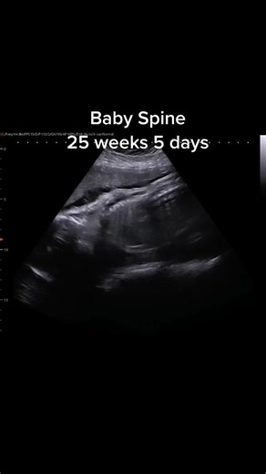 Baby Spine Ultrasound at 25 Weeks 5 Days