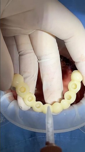틀니 버리고 전체임플란트 수술당일 임시치아 #dentist #dental #dentistry #implants