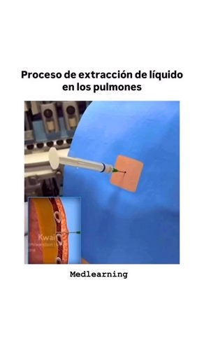 Medlearning | Capacitación Online on Instagram: "Toracocentesis: paso a paso explicado La toracocentesis es un procedimiento clave para drenar líquido pleural y mejorar la mecánica respiratoria del paciente. Indicaciones principales • Derrame pleural moderado a grande con síntomas • Sospecha de empiema o exudado • Necesidad diagnóstica (análisis del líquido pleural) Contraindicaciones relativas • Trastornos de coagulación sin corregir • Ventilación mecánica sin guía ecográfica • Derrames pequeño