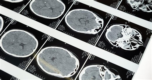 How Long Does Contrast Dye Stay in Your System? CT Scan Side Effects Explained