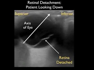How To: Ocular Ultrasound Part 2 Case Study Video