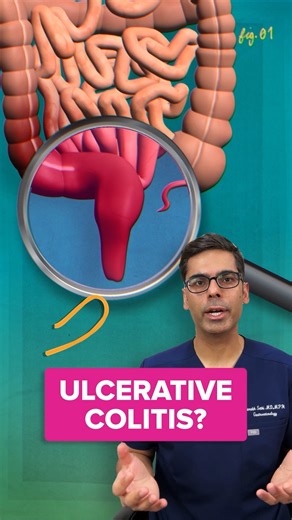 Are there new treatments for UC? 🤔 Dr. Sethi explains two new types of medication: biosimilars and JAK inhibitors, offering potential options for those with ulcerative colitis. 🧬💊 For more digestive health tips, follow us! 🌱 | Healthline