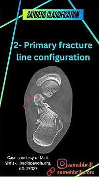Sanders classification for calcaneal fracture part 3