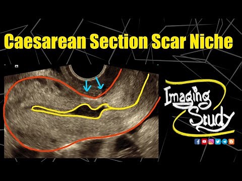 Caesarean Section Scar Niche || Ultrasound || TVS || Case 297