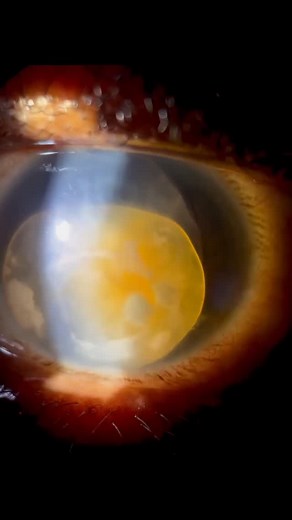 44K views · 300 reactions | Anterior lens dislocation The lens is the...