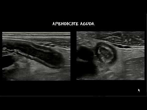 Apendicite / appendicitis