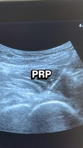 Hip injection with PRP #prp #hippain #lowbackpain #labraltear #stemcells