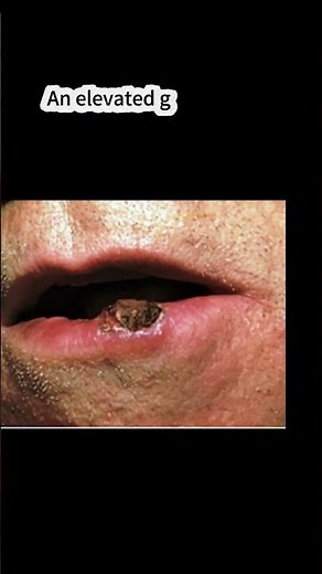 What Does Skin Cancer Look Like? Squamous Cell Carcinoma