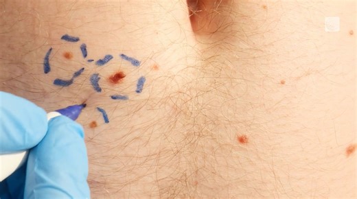 The importance of monthly skin checks: What you can (and should) do at home - The Weather Network