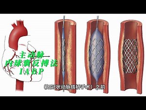 主动脉内球囊反搏法（Intra-Aortic Balloon Pumping，IABP）