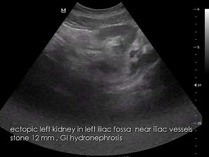 CASE 1043 ectopic left kidney with stone