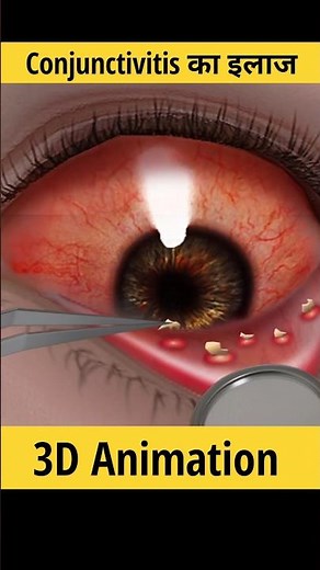 आंख अजाए तो कैसे ठीक करते हैं? | conjunctivitis treatment in 3D animation #shorts #conjuctivitis
