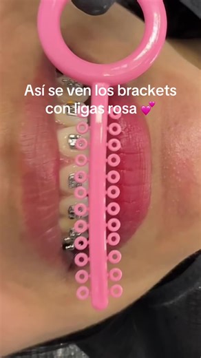 Brackets con Ligas Rosa: Estilo y Elegancia en Ortodoncia