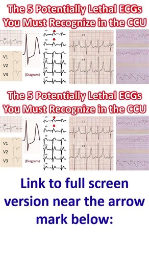 The 5 Potentially Lethal ECGs You Must Recognize in the CCU
