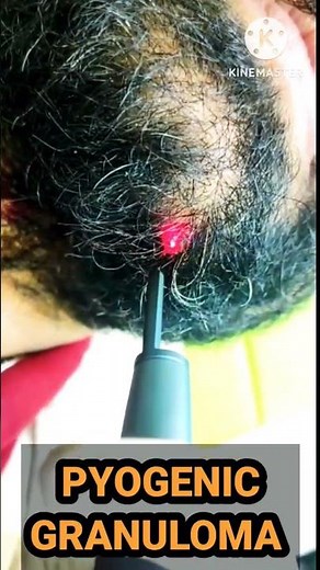 How to remove Pyogenic Granuloma//Pyogenic Granuloma Treatment//Pyogenic Granuloma Laser Treatment