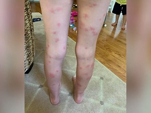 Several Kids Develop Swimmer's Itch After Swimming In Bangs Lake