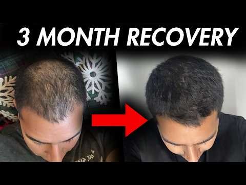 3 Month Hair Loss Recovery: Start Treatment Now!