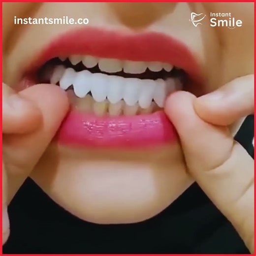 Perfect Smile Teeth SNAP ON VENEERS - Snap on teeth - Instant Smile Snap On Smile Veneers - 2026