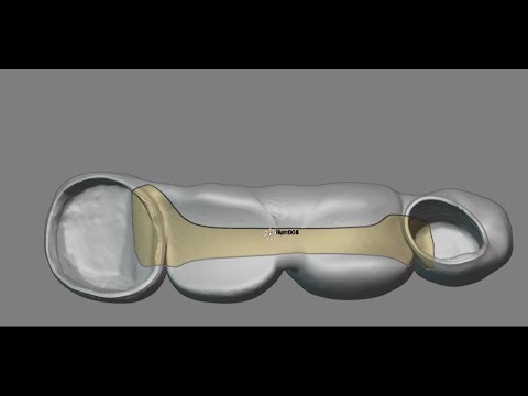 design an iBar on teeth in Blender4Dental